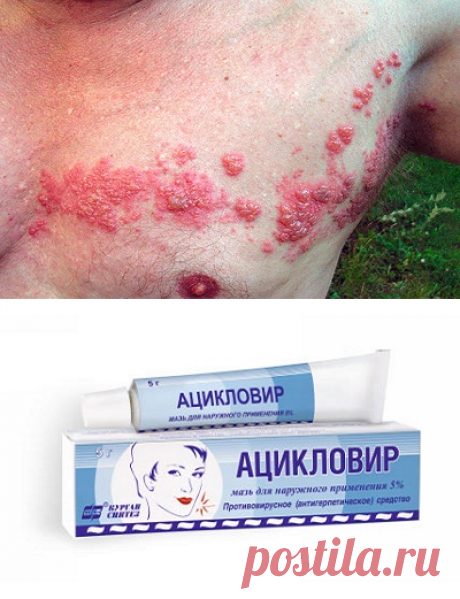 Лишай опоясывающий: лечение в домашних условиях народными средствами