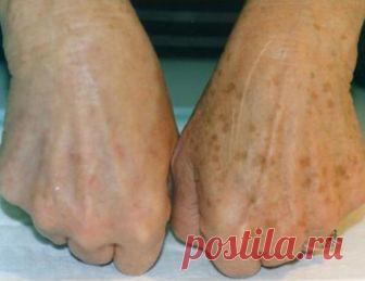 Возрастные пигментные пятна