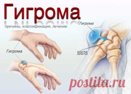 Гигрома. Ганглий. Причины, симптомы, диагностика, лечение.