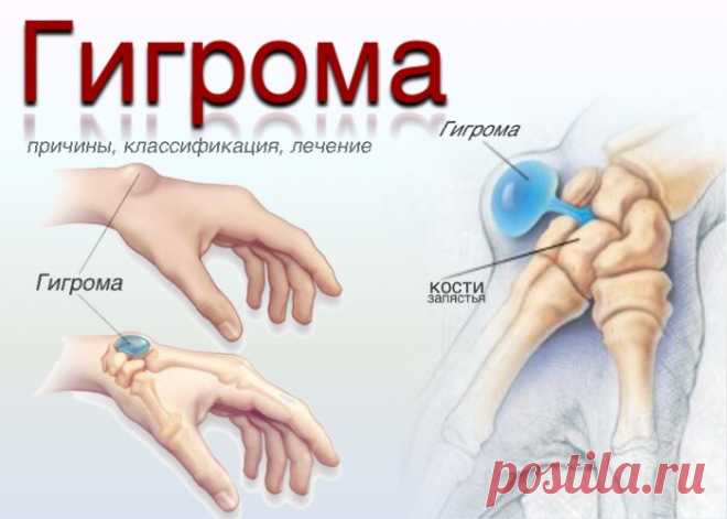 Гигрома. Ганглий. Причины, симптомы, диагностика, лечение.