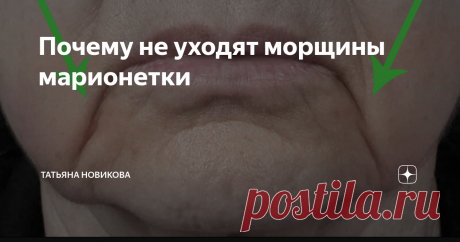 Почему не уходят морщины марионетки Всем привет! Отчего образуются морщины, идущие от уголка рта вниз? Их вызывает зажим треугольной мышцы лица. Со временем, из-за нашей активной мимики, эти мышцы спазмируются, укорачиваются, и у нас появляются те самые морщины-марионетки. Почему же упражнения на расслабление этой мышцы не помогают до конца справится с этими морщинами? На треугольные мышцы, а также и на весь низ лица сильно влияет подкожная мышца шеи - платизма. ► Когда пл...