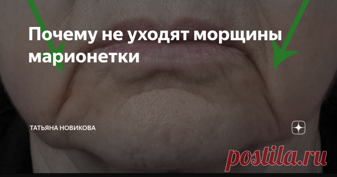 Почему не уходят морщины марионетки Всем привет! Отчего образуются морщины, идущие от уголка рта вниз? Их вызывает зажим треугольной мышцы лица. Со временем, из-за нашей активной мимики, эти мышцы спазмируются, укорачиваются, и у нас появляются те самые морщины-марионетки. Почему же упражнения на расслабление этой мышцы не помогают до конца справится с этими морщинами? На треугольные мышцы, а также и на весь низ лица сильно влияет подкожная мышца шеи - платизма. ► Когда пл...