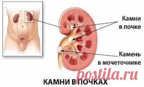ПОЧКИ И ИХ ЗАБОЛЕВАНИЯ