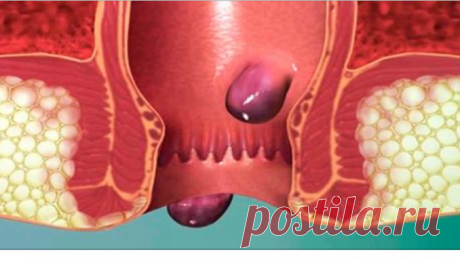 Вот почему возникает геморрой и 2 мощных старинных рецепта, которые избавят от этой проблемы раз и навсегда! — Полезные советы