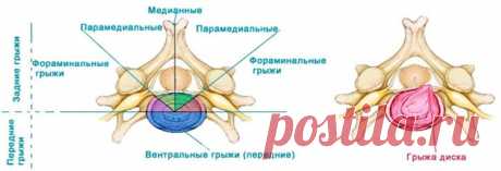 Фораминальная грыжа: первые симптомы, лечение, восстновление
Боли в спине случаются у каждого, особенно при неосторожных движениях. Однако зачастую они могут быть показателем серьезных заболеваний, таких как фораминальная грыжа. Фораминальная — это межпозвоночная грыжа, при которой межпозвоночное содержимое выпячивается в сторону спинного канала, зажимая при этом нервные окончания.