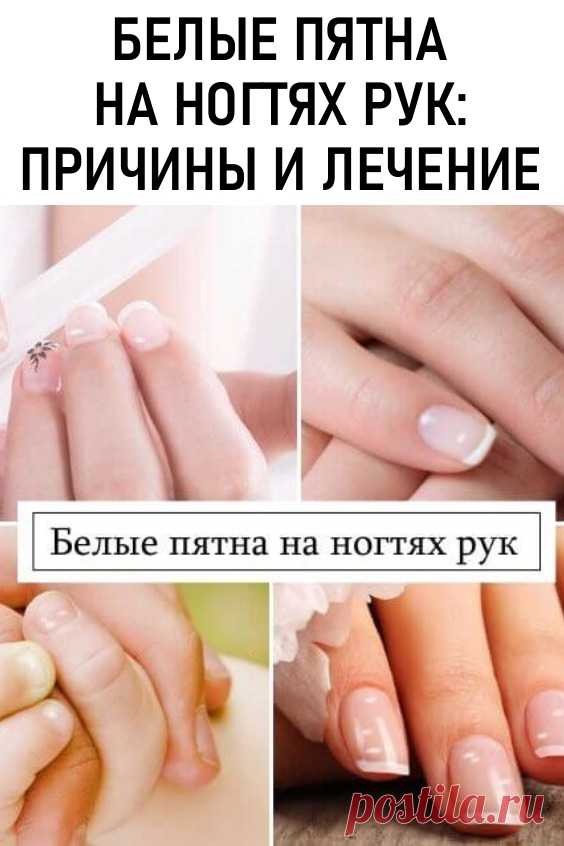 Белые пятна на ногтях рук как следствие нарушений в организме. Если пятнышек мало и по мере отрастания ногтя они исчезают, то волноваться нет причин. При постоянном появлении белых пятен или полосок не стоит их скрывать за маникюром, думая, что это всего лишь небольшая проблема. В этом случае может идти речь о такой патологии, как лейконихия.