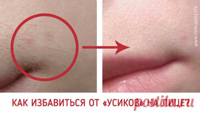 Как избавиться от «усиков» на лице?  Растительность над верхней губой у женщин — деликатная и довольно неприятная проблема. Как правило, причиной появления таких «усиков» является повышенный уровень тестостерона в организме (что, кстати…