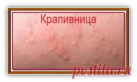 Что такое крапивница и как ее лечить — Всегда в форме!