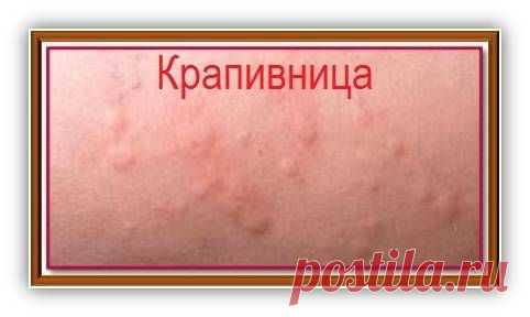 Что такое крапивница и как ее лечить — Всегда в форме!