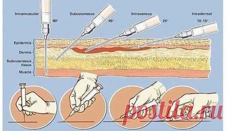 ПОД КАКИМ УГЛОМ ДЕЛАТЬ ИНЪЕКЦИИ