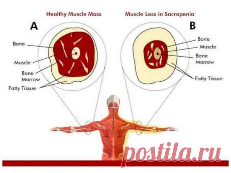 Что нужно знать о саркопении - медиаплатформа МирТесен Саркопенией называют возрастную атрофическую дегенеративную потерю мышечной массы и силы. В основном, эта патология развивается у людей после пятидесятилетия. Примерно у одного из десяти человек после 50 лет, возникают симптомы мышечной дегенерации. Это во многом объясняет падения и переломы у