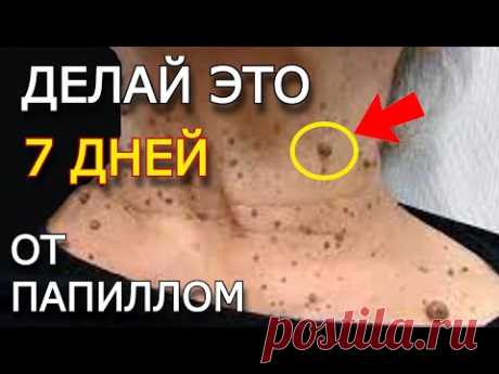 ОТПАДАЮТ САМИ. Секретный РЕЦЕПТ древних. Папилломы усыхают и исчезают самостоятельно ...