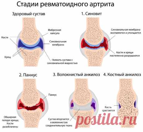 Вы любите мясо? Вам грозит артрит!