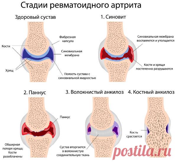 Вы любите мясо? Вам грозит артрит!