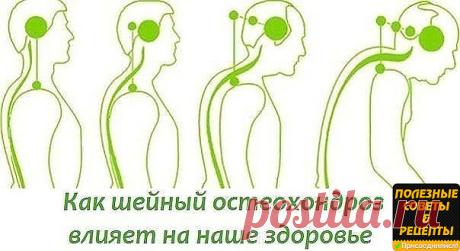 Здоровье >ШЕЙНЫЙ ОСТЕОХОНДРОЗ
