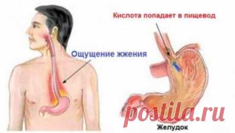 Сильная изжога: причины, что делать в домашних условиях