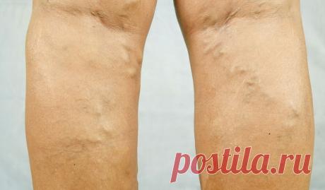 Лечение тромбоза глубоких вен. Причины и факторы появления. • Сияние Жизни