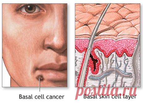 The North America basal cell and squamous cell carcinoma therapeutics market size was USD 578.2 million in 2020 and is projected to grow from USD 825.6 million in 2021 to USD 2,353.4 million in 2028 at a CAGR of 16.1% in the 2021-2028 period.
