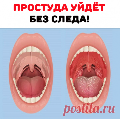 Смешиваю по 2 ч.л. ротокана (продается в аптеке. Это смесь настоек ромашки, тысячелистника и календулы), касторового масла и раствора люголя.

Наматываю на указательный палец бинт, смачиваю его в этом составе и бесстрашно смазываю горло сначала с одной стороны, затем - с другой. Готовить смесь нужно непосредственно перед применением, НЕ ХРАНИТЬ!

Помогает стопроцентно, а главное - очень быстро. Если горло только-только начало болеть, достаточно 2-3 смазывания. Ангина - после 5-6 процедур