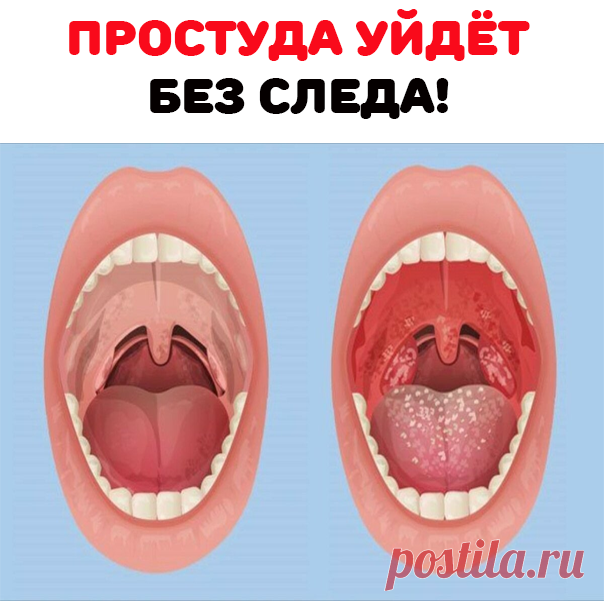 Смешиваю по 2 ч.л. ротокана (продается в аптеке. Это смесь настоек ромашки, тысячелистника и календулы), касторового масла и раствора люголя.

Наматываю на указательный палец бинт, смачиваю его в этом составе и бесстрашно смазываю горло сначала с одной стороны, затем - с другой. Готовить смесь нужно непосредственно перед применением, НЕ ХРАНИТЬ!

Помогает стопроцентно, а главное - очень быстро. Если горло только-только начало болеть, достаточно 2-3 смазывания. Ангина - после 5-6 процедур