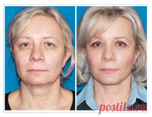 Быстрая подтяжка лица