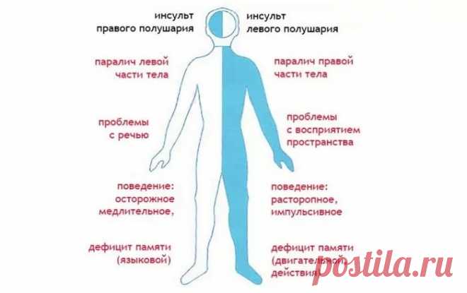 какие критерии определяют получении инвалидности после инсульта: 5 тыс изображений найдено в Яндекс.Картинках