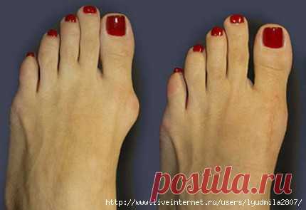 КОСТОЧКИ на ногах-РЕЦЕПТЫ ЛЕЧЕНИЯ