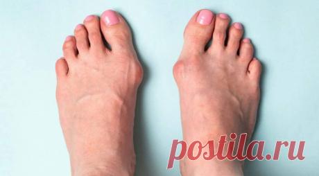 «Косточка на ноге» — не просто косметический дефект: что на самом деле происходит, почему это больно и как жить дальше | Советы для здоровья | Дзен
