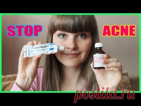 Чистая кожа. 2 часть / Как избавиться от прыщей и следов от них?