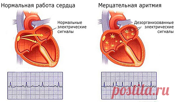 5 простых способов успокоить сердце при аритмии