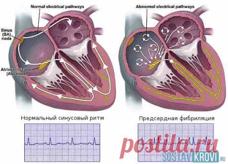 Нарушение проводимости сердца: на экг, виды, лечение, осложнения и прогноз