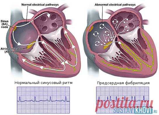 Нарушение проводимости сердца: на экг, виды, лечение, осложнения и прогноз