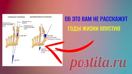 Халюс вальгус (Hallux Valgus). Неудобная правда. Тяжелые последствия. | Кузнецов Иван. Физкультура по науке. ЛФК. | Дзен