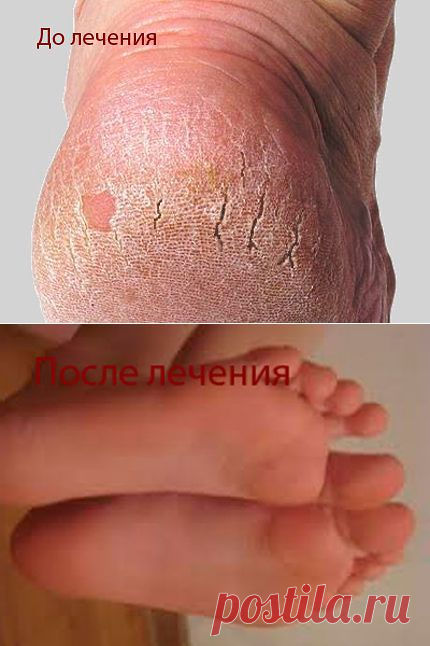 Пяточки