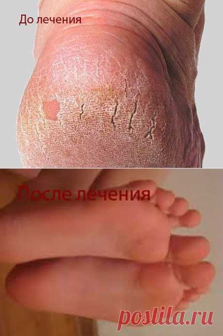 Пяточки