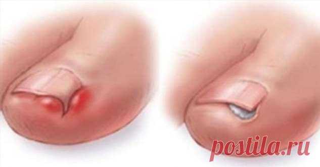 Без Визита К Хирургу Убираем Вросший НОГОТЬ | Люблю Себя