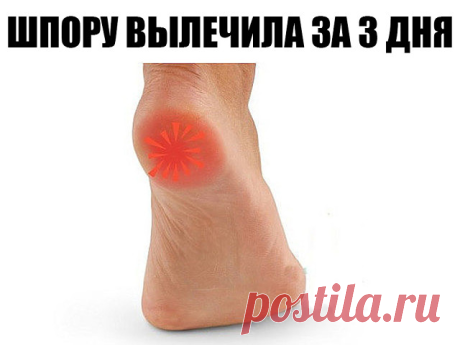 ШПОРУ ВЫЛЕЧИЛА ЗА 3 ДНЯ

Поделюсь рецептами от пяточных шпор. Прошлым летом на юге после ванн у меня так разболелась нога, что я не знала, куда ее деть. Пятка горела огнем. Приехав домой, побежала к хирургу. Молодая врач сделала снимок и объявила, что у меня после ванн обострилась пяточная шпора. Дала мне какую-то «памятку» - и все. Я поняла, что надо самой лечиться. Обратилась к народной медицине - стала искать рецепты от шпор. Все, что нашла, выписала и посылаю вам. Ведь...