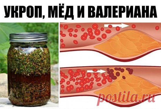 Укроп, мёд и валериана! Всего 1 столовая ложка сотворит чудо с твоими сосудами.
К сожалению, наши кровеносные сосуды имеют свойство загрязняться. Они накапливают на своих стенках отложения неорганических солей, что в дальнейшем является причиной развития атеросклероза, нарушения кровообращения, повышенного давления и варикоза.
Поэтому рекомендуется регулярно проводить курс очищения кровеносной системы. Сегодня наша редакция поделится с тобой проверенным методом очищения сосудов…
Как почистить