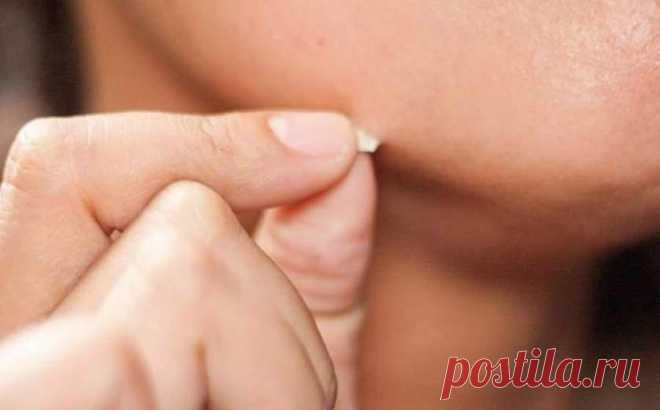 5 способов избавления от папиллом в домашних условиях: что-то вам точно поможет (советы по применению)