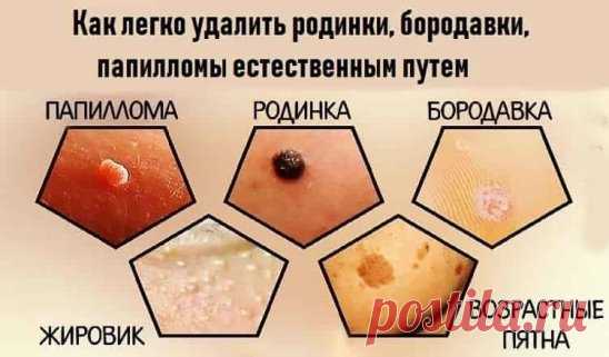 Как легко удалить родинки, бородавки, папилломы естественным путем
