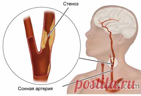Стеноз сонной артерии: причины, симптомы, методы лечения и прогноз