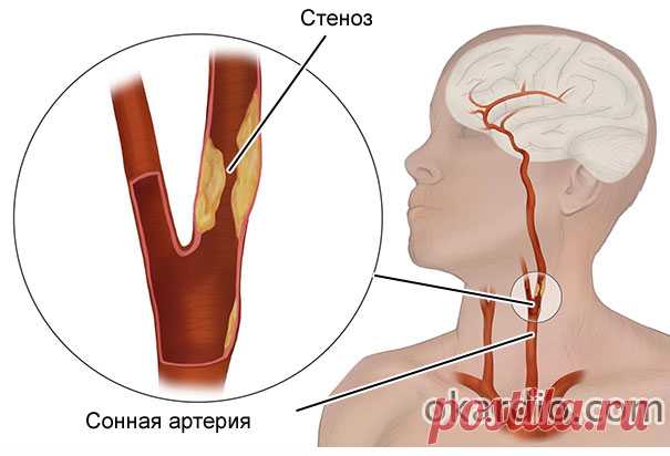Стеноз сонной артерии: причины, симптомы, методы лечения и прогноз