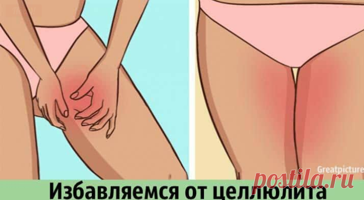 Избавляемся от целлюлита. 
Целлюлит касается не только пышных женщин, которые отличаются от остальных избыточным весом. Это своеобразные отложения под кожей, которые формируются в результате многих факторов. Это может быть и малоподвижный привычный образ жизни и злоупотребление современной быстрой едой (фастфуды).

Целлюлит можно смело назвать заболеванием, которое можно успешно излечить