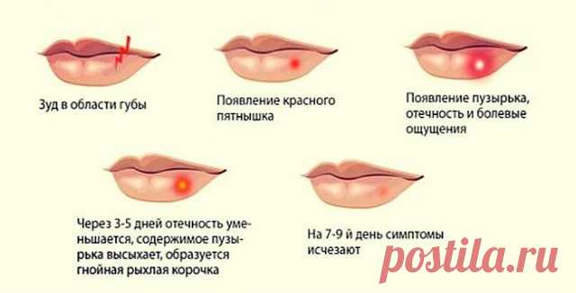 Как избавиться от герпеса на губах. Экстренная помощь и лечение в домашних условиях — Копилочка полезных советов