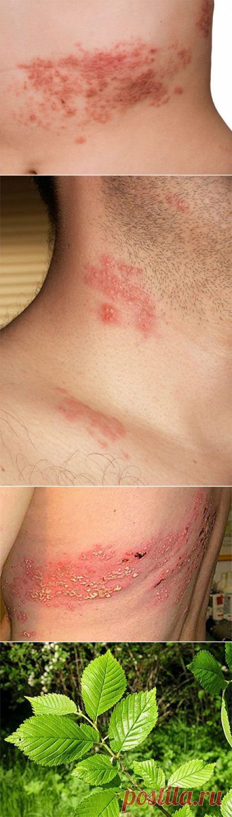 Опоясывающий лишай: симптомы и лечение / Будьте здоровы