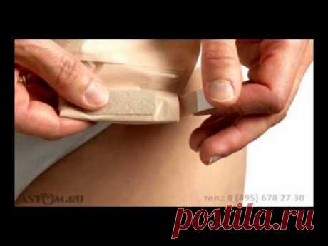 Как клеить калоприемники Колопласт. Уход за колостомой. - YouTube