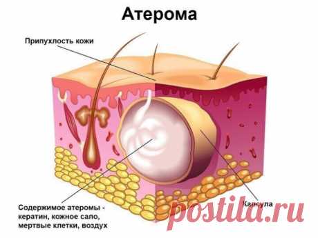 АТЕРОМА (ЖИРОВИК)