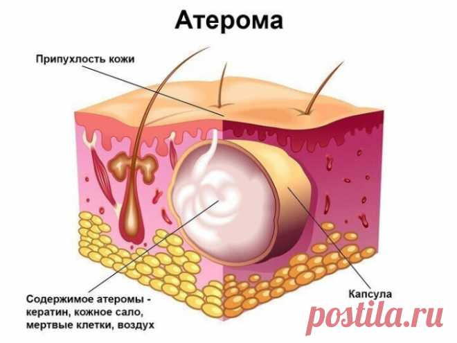 АТЕРОМА (ЖИРОВИК)