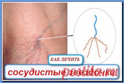 Что делать с венозными звёздочками.
