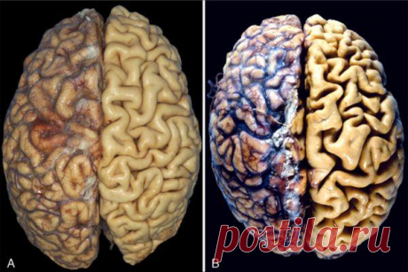 Атрофия головного мозга: разновидности, признаки, лечение, последствия